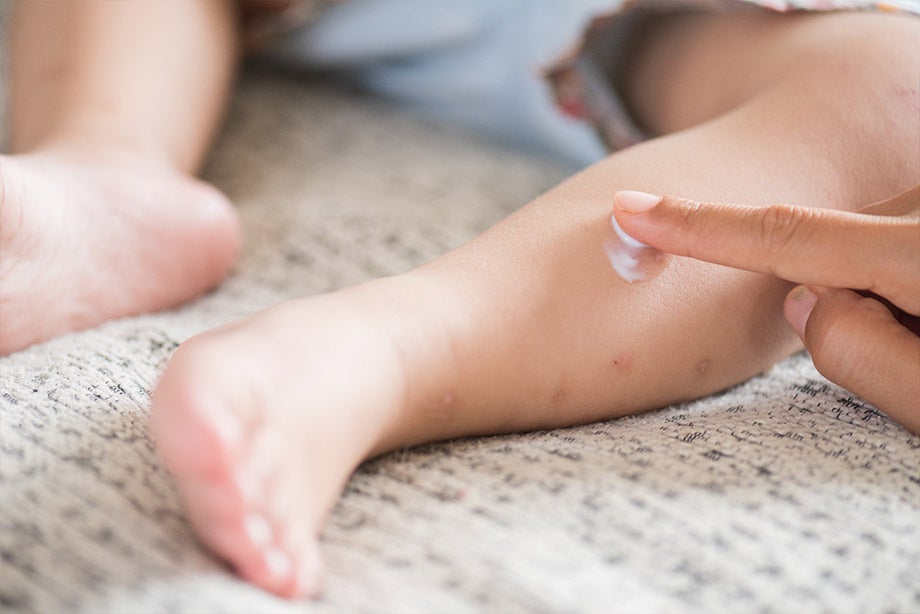 Mẹ hãy đặt một túi chườm đá lên vùng bị thương, thoa kem chống sẹo và xịt thuốc giảm đau khi trẻ bị thương sưng tấy