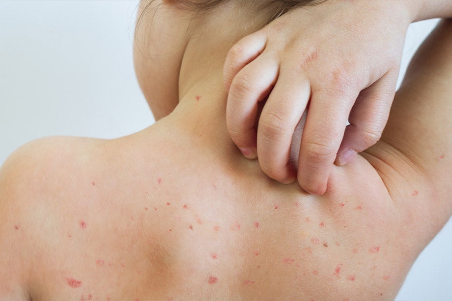 Khi con bị phát ban ngoài da, mẹ cần giữ gìn vệ sinh sạch sẽ cho trẻ