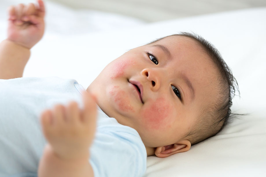 Hệ miễn dịch của bé phản ứng với thành phần đạm có trong sữa bò và chế phẩm từ sữa bò gây ra dị ứng đạm sữa bò sữa
