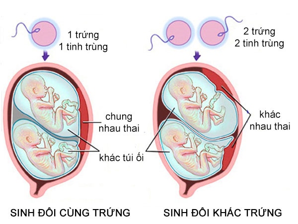 Mang thai sinh đôi: Mẹ cần chuẩn bị gì