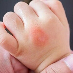 Mẫn đỏ Mẫn đỏ
